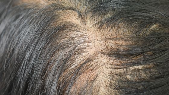 Why does men’s hair get thinner?